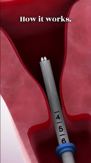 Kyleena Explained #kyleena #IUDdevice #hormonalbirthcontrol #medicalcentric #contraceptivetips