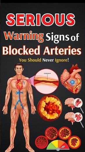 The Top WARNING Signs Your Arteries Are Blocked
