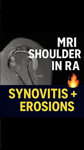 “MRI of Rheumatoid Arthritis Shoulder | Classic Synovitis & Erosions Explained”#RheumatoidArthritis
