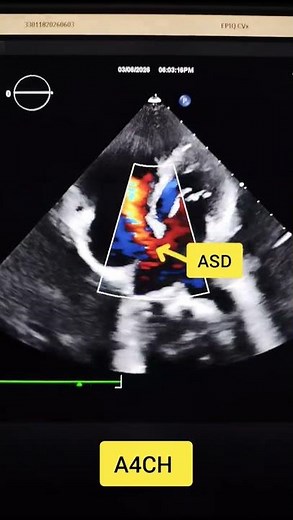 ASD (Atrial Septal Defect)