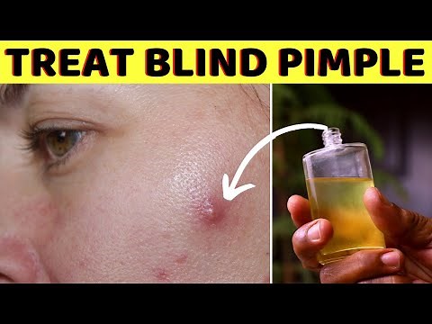 How to get rid of a blind pimple with no head fast overnight