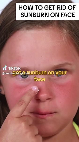 5 Home Remedies to Soothe Sunburn on Your Face