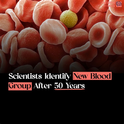 The discovery of the MAL blood group is a significant breakthrough in hematology. However, several questions remain unanswered. How does the absence of the AnWj antigen affect the overall health and function of red blood cells? Are there any specific health risks or complications associated with having the MAL blood type? The link of the article this video is based on: https://ashpublications.org/blood/article-abstract/doi/10.1182/blood.2024025099/517404/Deletions-in-the-MAL-gene-result-in-loss-