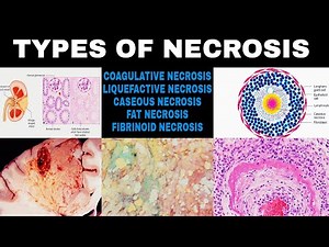 NECROSIS , PART - 2 | Types Of Necrosis