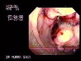 Endoscopic Image of Adenocarcinoma Of The Cecum • Video • MEDtube.net