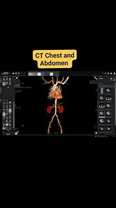 CT Chest and Whole abdomen Contrast : 70 ml Saline :30 ml ROI: Aortic arch Cannula : 20 G S.creatinine : It must be a normal value Machine : Siemens Somatom Go.Top | CT Scan and MRI study