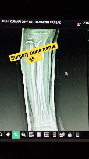 tibia bone surgery x-ray #youtube #youtubeshorts #viral #ytshorts #viralshorts ‪@YouTube‬