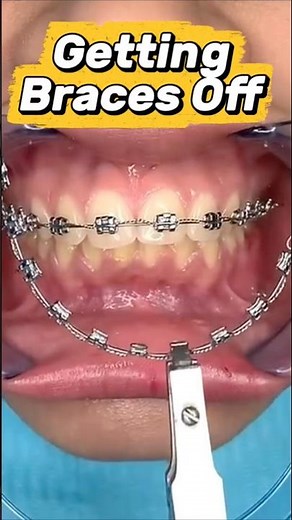 Getting Braces Off! Quick and painless ✨ #orthodontist #braces #bracesoff