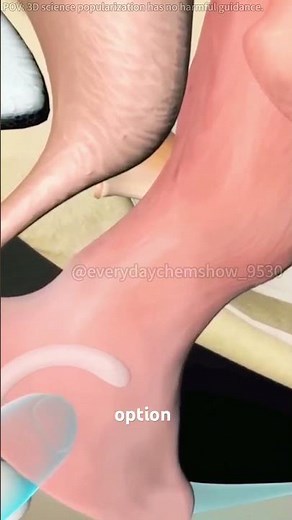 Vaginal Pessary Ring Insertion Procedure 3D Animation#vaginalpessaryring #pessaryinsertion