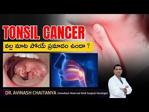 What are the symptoms of tonsil cancer | Dr.Avinash Chaitanya | Kaizen Hematology Oncology Network