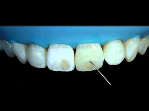 Removal of white spots on teeth with DMG ICON