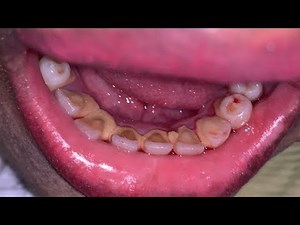 Deep Cleaning With HEAVY Tartar Build Up At The Dentist