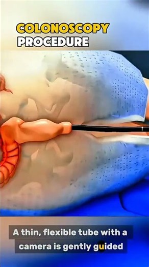 Colonoscopy procedure medical 3d animations #Colonoscopy #ColonoscopyProcedure