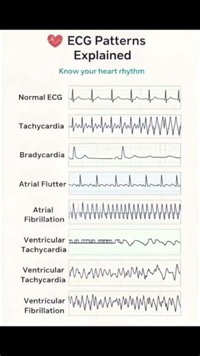 🩺 ECG PATTERN ❤️#ecg#norcet#aiims#medical#viral#shorts#youtubeshorts#growth#explore#trending#viral