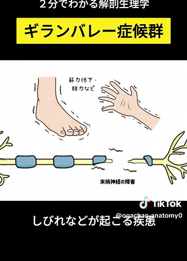 ギラン・バレー症候群の解説とカンピロバクター