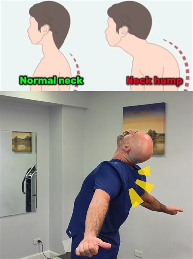 Fix Your Neck Hump 🎥 Video by Dr. Rodion Narkolayev 🏅 Board Certified Physical Therapist 💪 Certified Advanced Manual Therapist 📧 Email: hello@truebodypt.com 📍 Address: 65-36 99th Street, Suite #1D Rego Park, New York 11374 📞 Phone: 718-897-6869 917-886-5667 ⚠ Disclaimer: This video is for educational purposes only and does not replace professional medical advice. If you experience pain or have a medical condition, please consult a qualified healthcare professional before trying any exercis