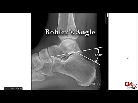 Calcaneal Fractures