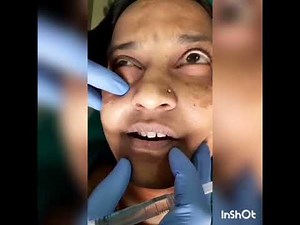Demonstration of infraorbital nerve block