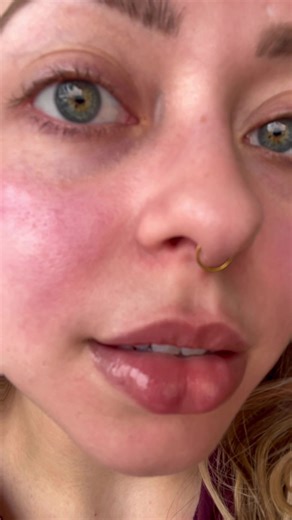 Understanding Lupus and Butterfly Rash Symptoms