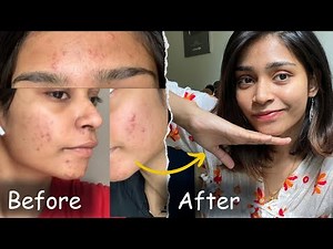 This Changed my life….! | No product | No doctor | Acne journey Tamil