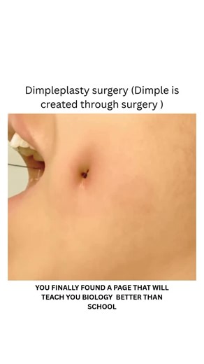 BIOLOGY | MEDICAL | HEALTH on Instagram: "Dimpleplasty is a minimally invasive cosmetic surgery to create natural-looking dimples on the cheeks or chin by using a small incision inside the mouth to suture the skin to the underlying muscle. The procedure is typically quick, performed under local anesthesia, and has a short recovery period. Patients can resume normal activities within a couple of days, though some mild swelling is normal. Dm for credit or removal 👏🏻🙏🏻 For educational purposes 