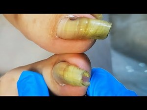 Trim extra long toenail like cicada chrysalis | Satisfying video