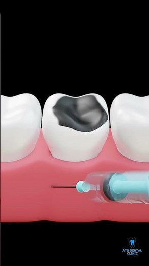 Tooth Extraction Explained