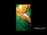Mesentric Cyst Surgery • Video • MEDtube.net