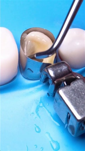 ROOT CANAL TREATMENT. Endodontic restoration. #endodontist #compositerestoration #dentalprosthesis