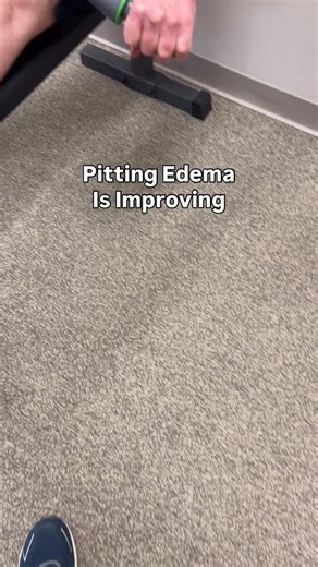 Pitting edema is improving. Exercise and self massage can help. But getting the proper medical assessment is important. | Total Therapy Solutions: Physical Therapy