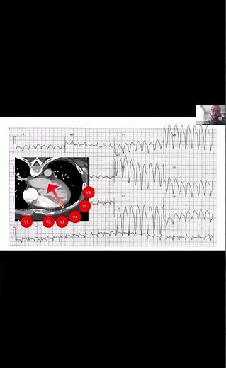 Taquicardia Ventricular. ¿Cómo Diferenciarla en un ECG. - Dr. Gabriel Londoño