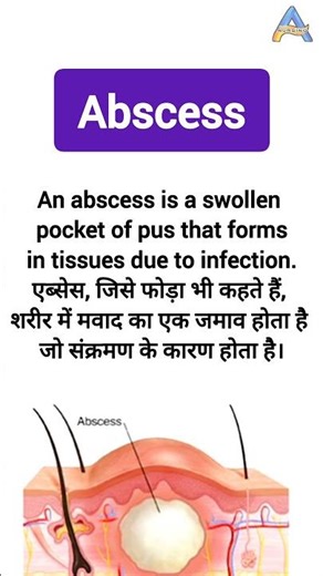 Abscess medical term | Abscess means | Abscess ka matlab | Pus formation ‪@anandsnursingfiles‬