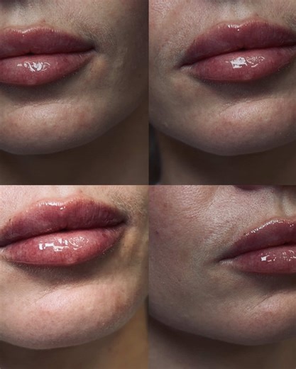POV: you wanted lips that are crisp, plump, and literally to die for 🖤🔪💀 We used Restylane Kysse to enhance her natural shape, define that border, and give her that perfect pillowy fullness without looking overdone. I’m obsessed with how clean and crisp her lines are… just juicy, balanced, and effortless. This is what happens when technique meets intention. We don’t just add volume over here — we’re conjuring confidence ✨ If your lips need a little structure, a little plump, or a full transfo