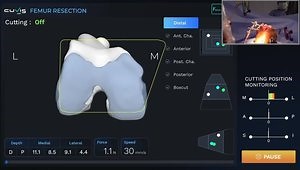 Joint active robotic knee replacement- Dr. Chandrashekar P