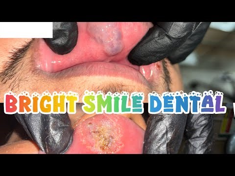Large Capillary Upper Lip Hemangioma – Single-Visit Treatment with Soft Tissue Diode Laser