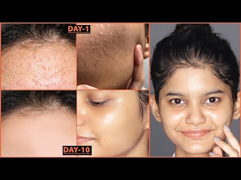 How to remove TINY BUMPS Naturally at HOME | Get Rid of TINY BUMPS/BUMPY SKIN Naturally |