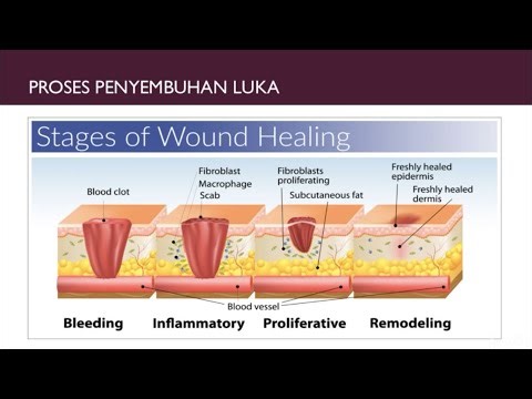 Tahapan - tahapan penyembuhan luka yg perlu kita kenali.. Tutorial Vaskuler