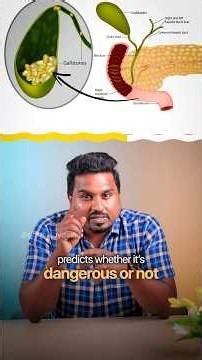 Even a single stone in a gall bladder becomes a danger | Gut Health | Dr Davis