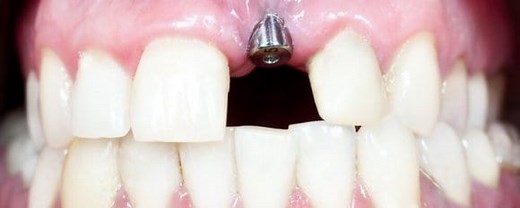 Remboursement implant dentaire en 2026 : comment ça marche ?