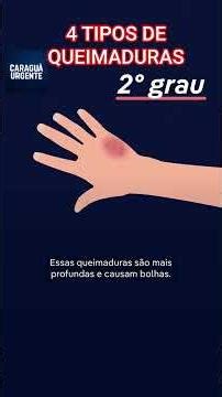 Learn about and classify the 4 types of burns that exist.