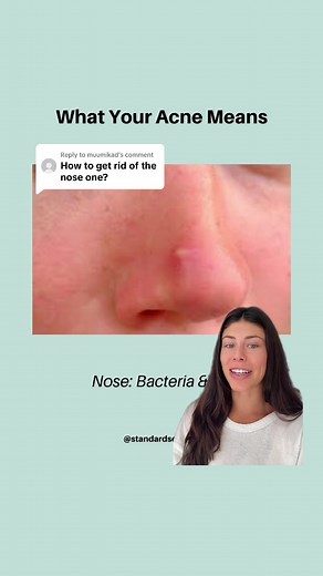How to Treat Nose Acne: Tips & Skincare Products