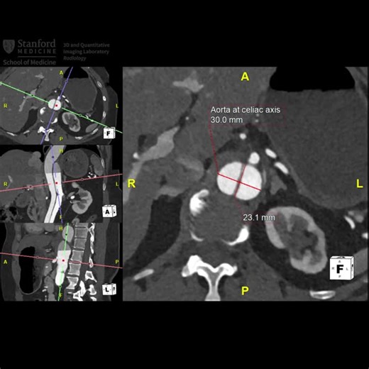 Aortic Dissection Monitoring: Standardized Measurement Techniques | Stanford 3D & Quantitative Imaging Laboratory posted on the topic | LinkedIn