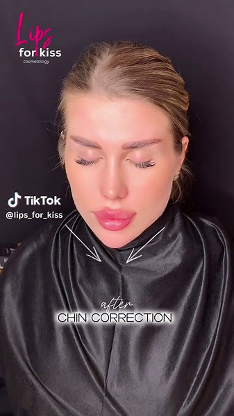 Chin correction 💉 before and after 📍Moscow | Dubai | London appointments Schedule an appointment with one of our talented aesthetic doctors 👉 Sign up now: www.LFK-academy.com #recommendations #cosmetology #skincare #fyp #fashion #estetik #lipfiller #jawline #fullface #botox #lifting #beauty#увеличениегуб #увеличениегубмосква #fullface #fullfaceмосква #fullfaceuk #lipfillersessex #lipaugumentation #коррекцияскул #lipfilleruk #коррекцияугловмосква #коррекцияскулмосква #лицоподключ #lipsaugmenta