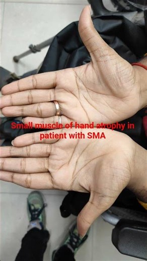 small muscle of hand atrophy in patient with SMA