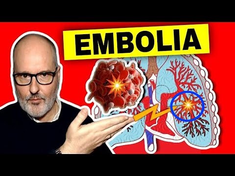 PULMONARY EMBOLISM: Symptoms, Causes, Prevention and Solutions