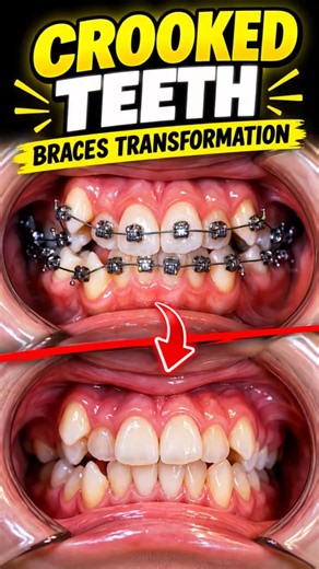😳 CROOKED TEETH TO STRAIGHT?! 🤯🦷 BRACES TRANSFORMATION!#shorts #dentalartistry#orthodontist #dentist