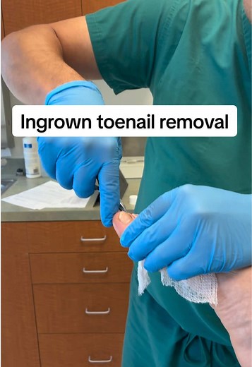 Ingrown Toenail Removal by Doctor Nik