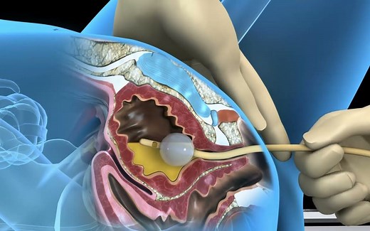 导尿术动画演示