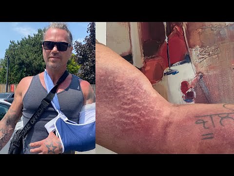 Day1: Tricep Tendon Tear/Hiccups/Recovery