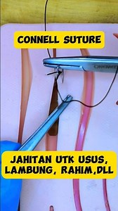 Connell Suture. This Suture is suitable for intestine, stomach, vesica urinary and uterus.